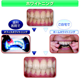 ホワイトニング