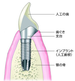 インプラント